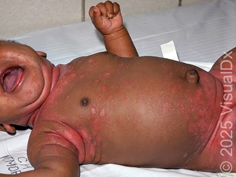 Seborrheic dermatitis frequently involves the diaper area and other body folds, as seen in this infant.