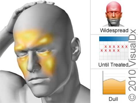 Sinus headaches involve pressure or pain in the forehead, brow, below or behind the eye, behind the ear, and, occasionally, sensitivity in the upper gums. The pain is typically focused in one area and lasts until treated.