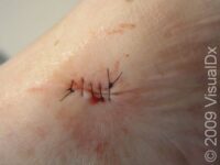 Suture, Surgical – Cosmetics