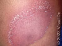 Generalized Pustular Psoriasis