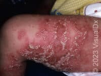 Generalized Pustular Psoriasis