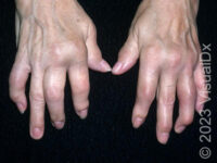 Psoriatic Arthritis