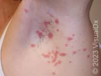 Guttate Psoriasis – Adult