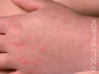 Guttate Psoriasis – Child