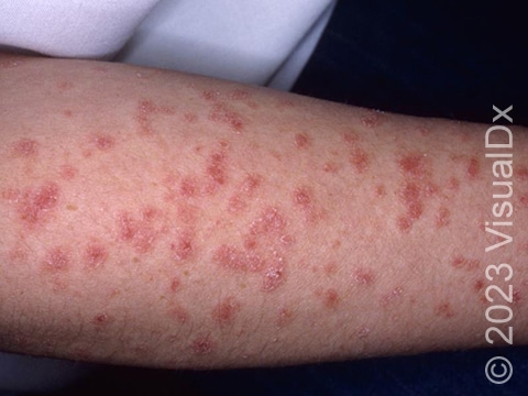 The typical red, scaly features of guttate psoriasis, involving an extremity.