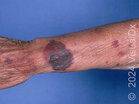 Purple bruise-like patches, some flat and some slightly raised, on the forearm and hand.