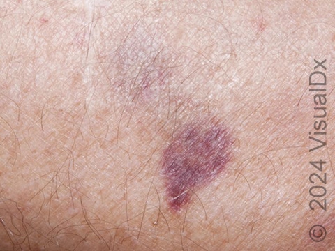 A close-up of a purple patch and a faint scar.