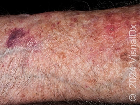 Bruised and reddish, scabbed patches on the forearm. The surrounding skin is thin and discolored due to decades of sun exposure.