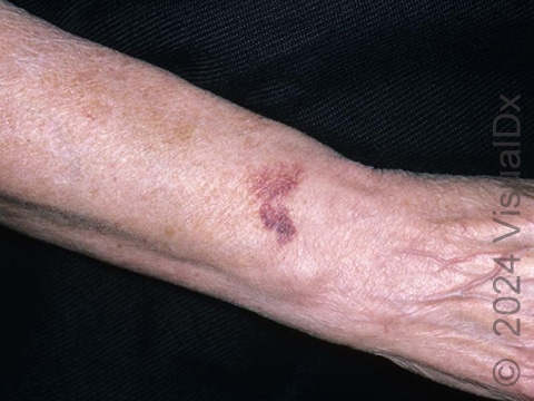 A bruised patch on the forearm. The surrounding skin is thin and discolored due to years of sun exposure.